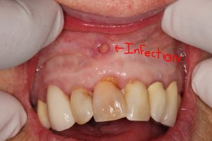 Infection in Jaw after Root Canal Treatment 20 years ago.